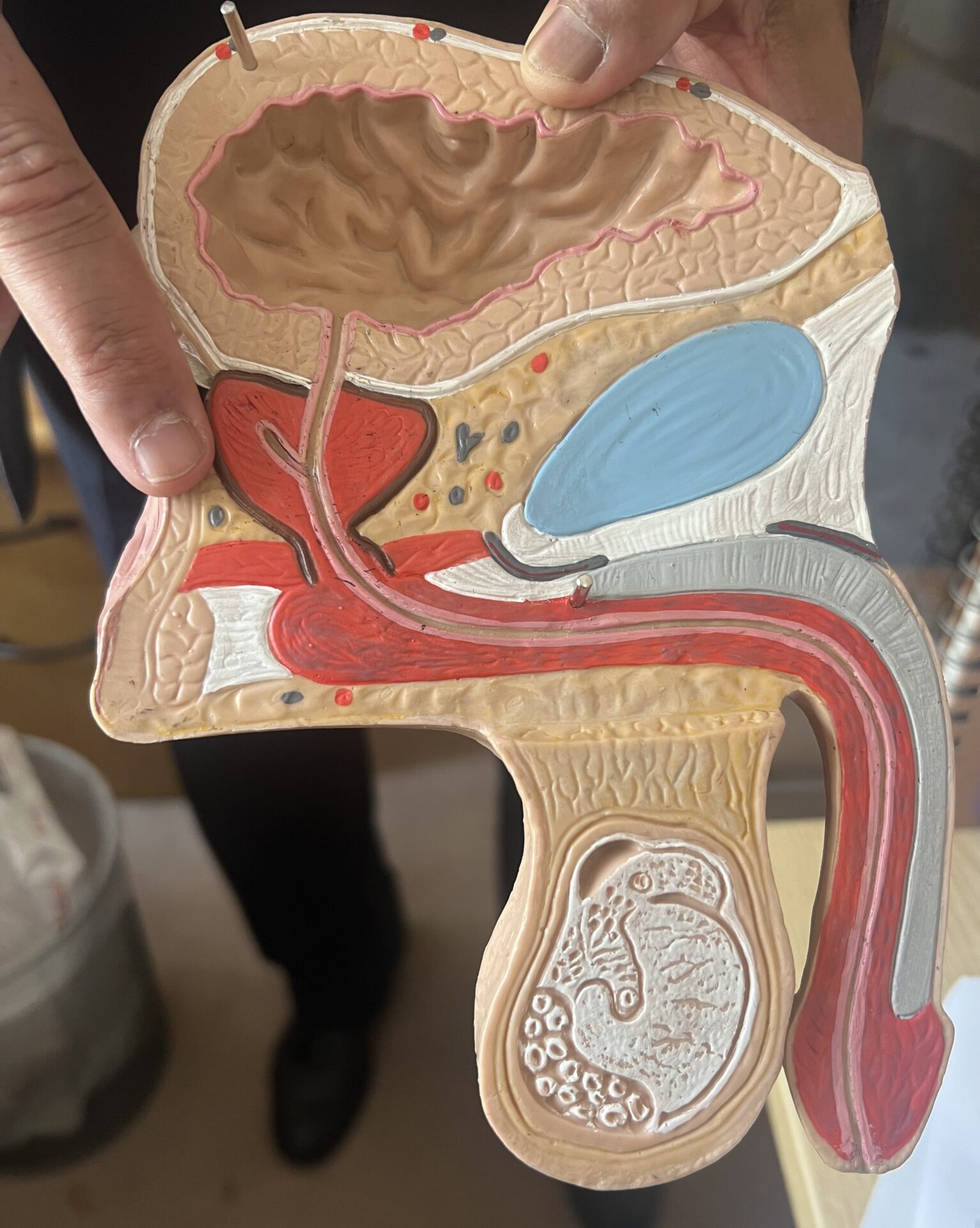 recovery after prostate cancer surgery